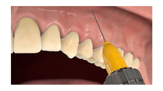 Έλεγχος πόνου