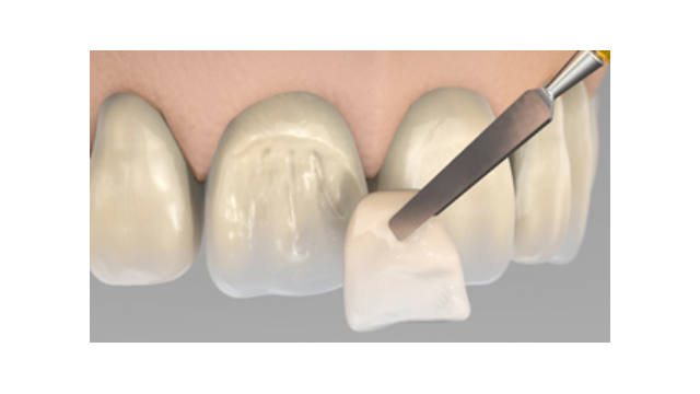 Ρητίνες επικάλυψης σκελετών